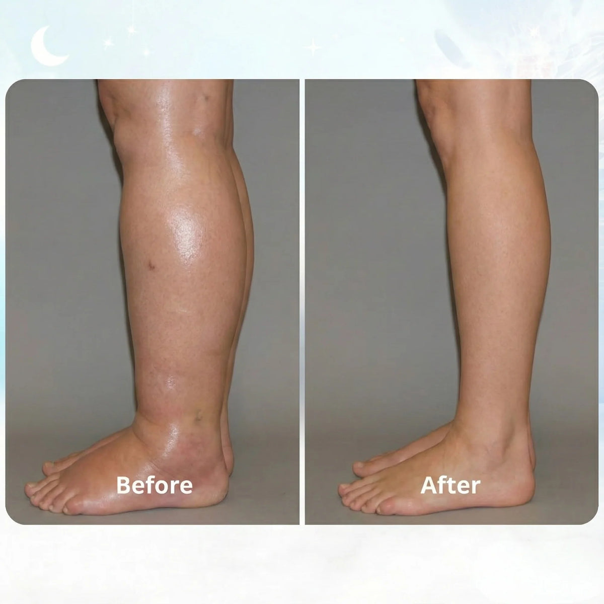 FIX SWOLLEN LEGS FROM HOME