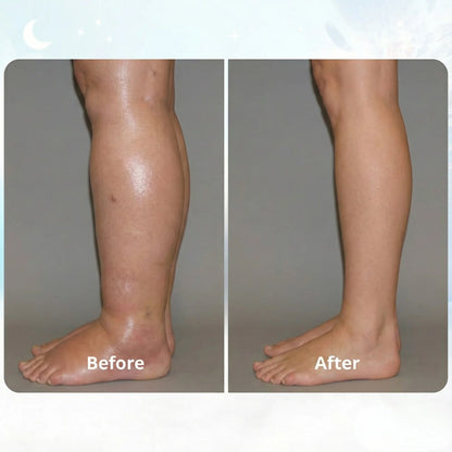 FIX SWOLLEN LEGS FROM HOME