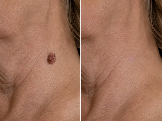 Before and after - Enalyn
