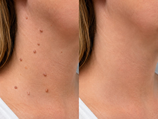Before and after - Neumann
